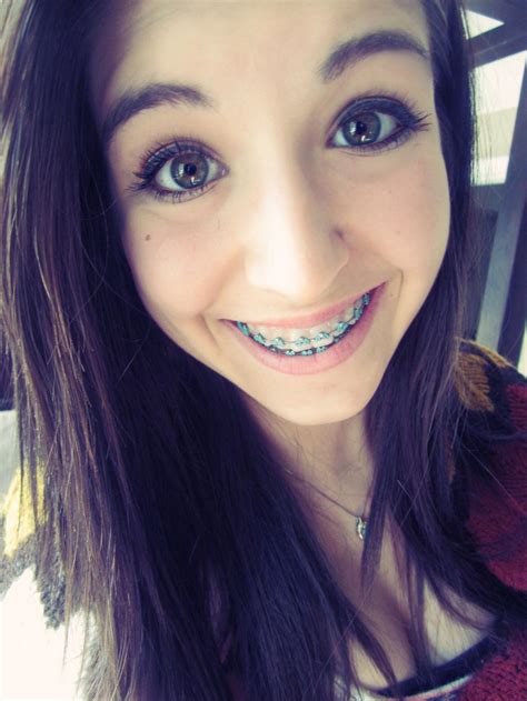 Braces girl : r/bracesgirlr